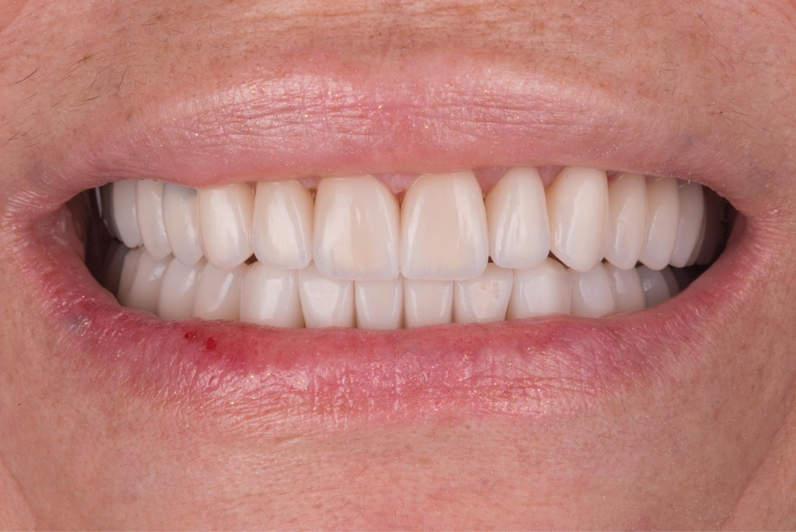 Caso clínico Evolux - reabilitação estética do sorriso 1