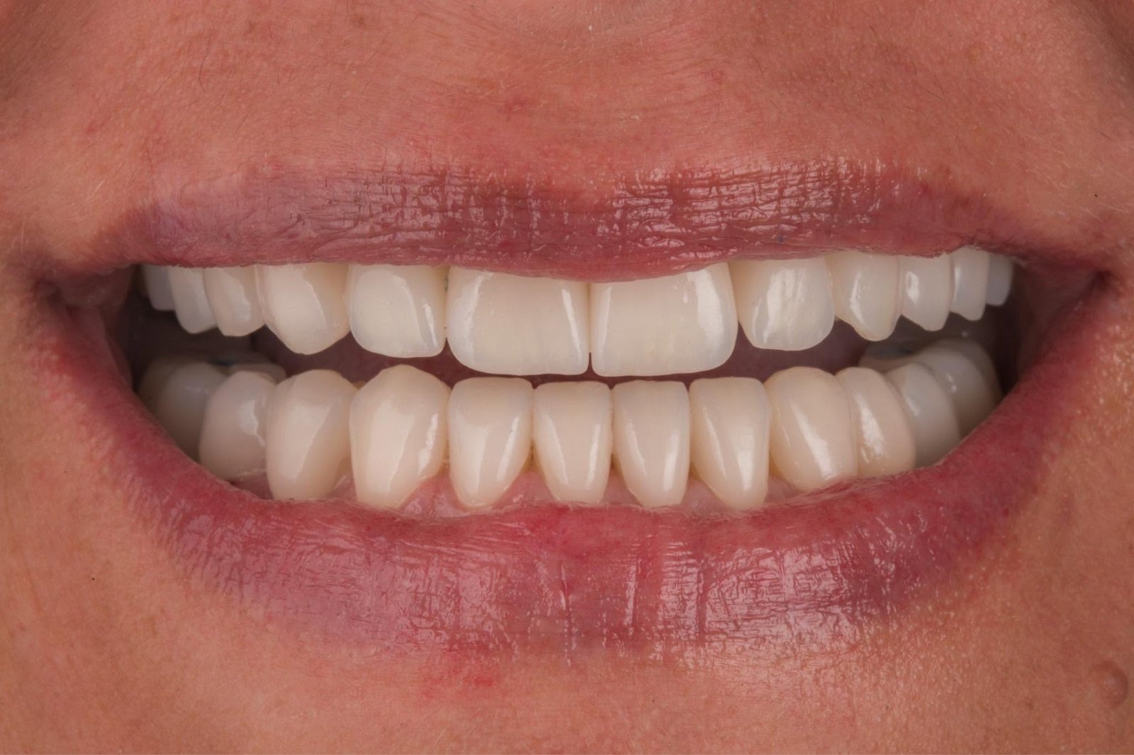 Caso clínico Evolux - reabilitação estética do sorriso 2