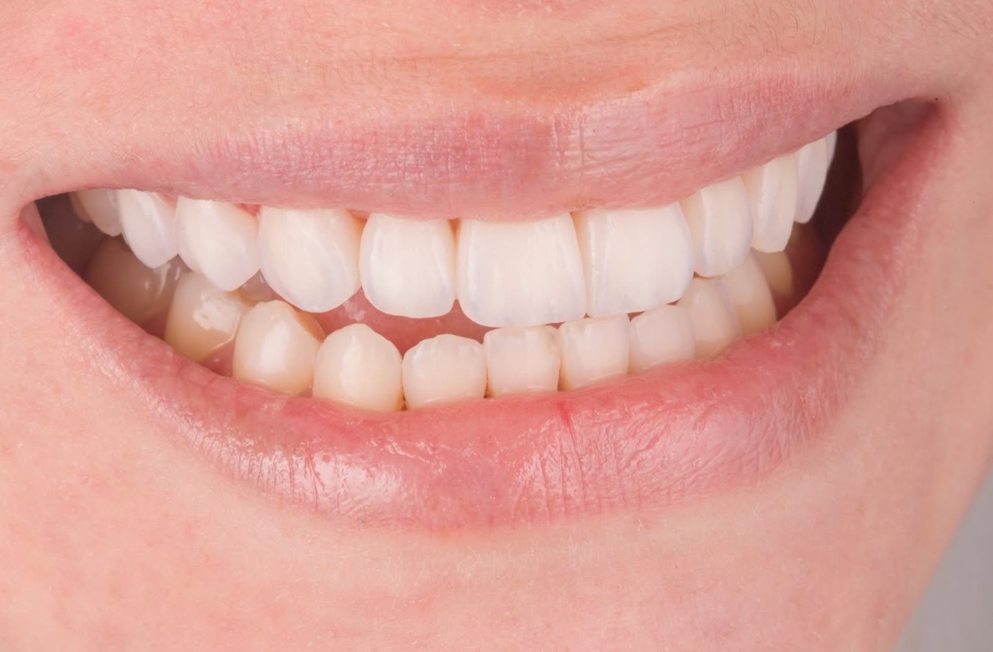 Caso clínico Evolux - reabilitação estética do sorriso 3